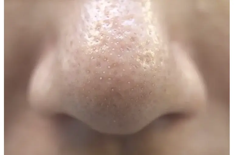 つまり毛穴